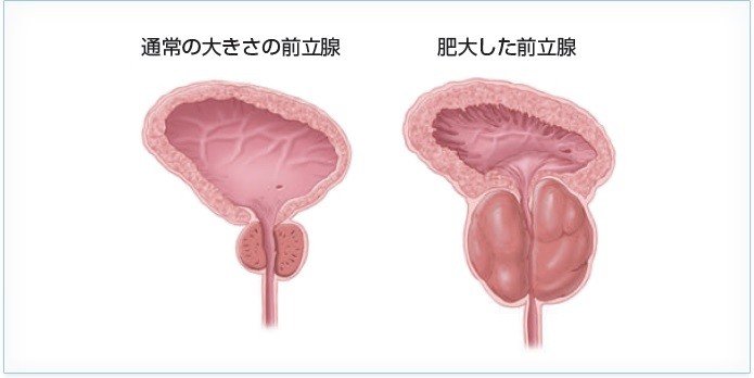 通常の前立腺と肥大した前立腺の比較イラスト